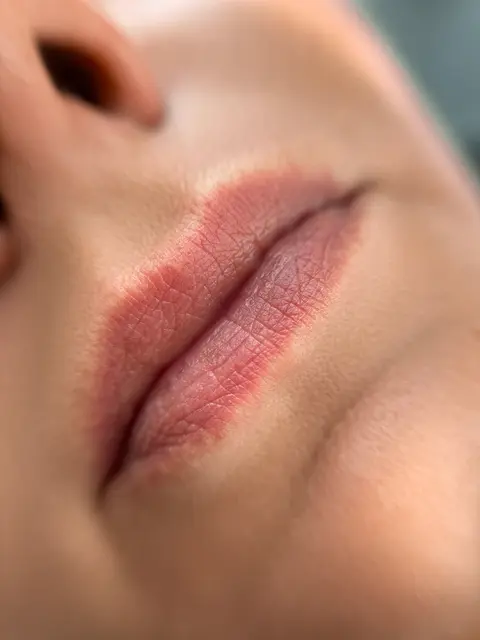 Labios: antes